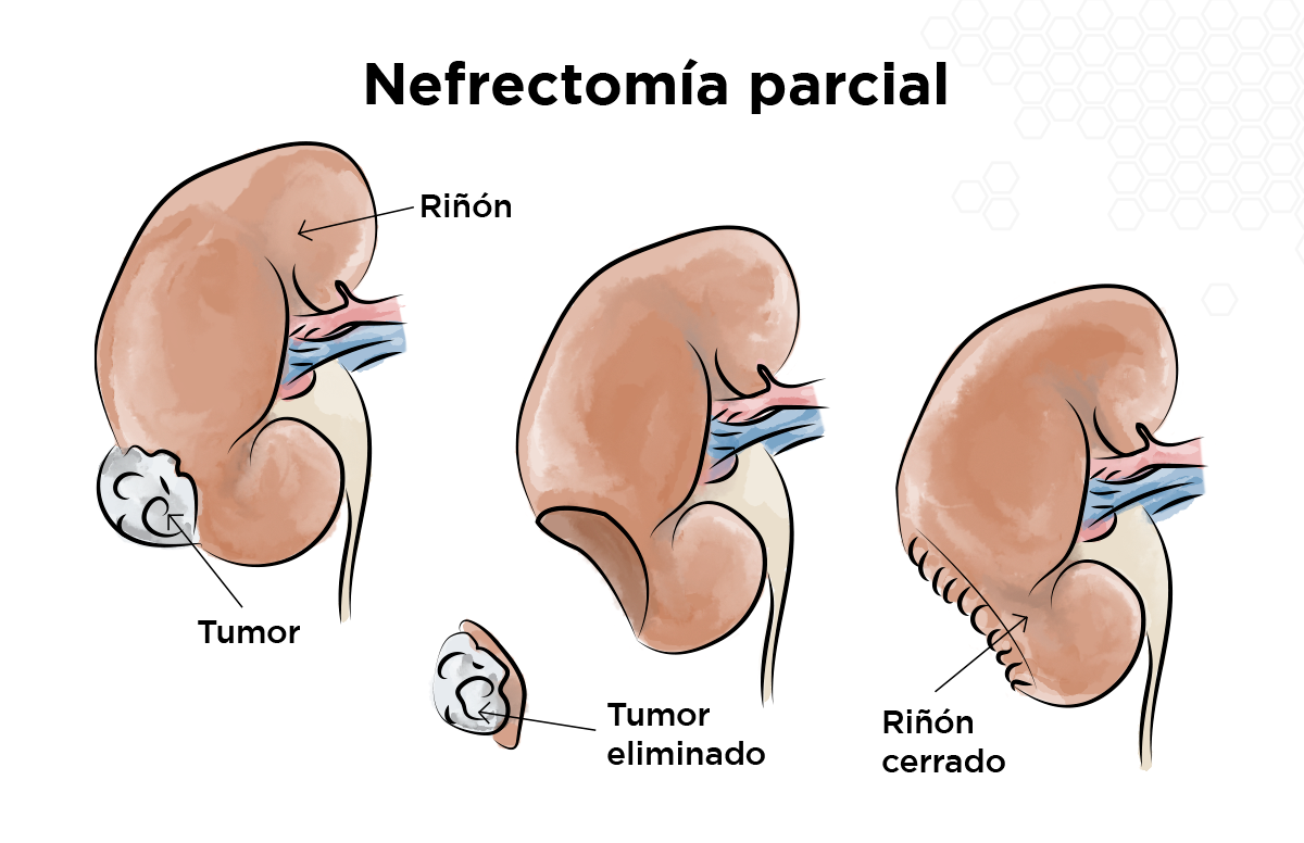 Nefrectom�a parcial