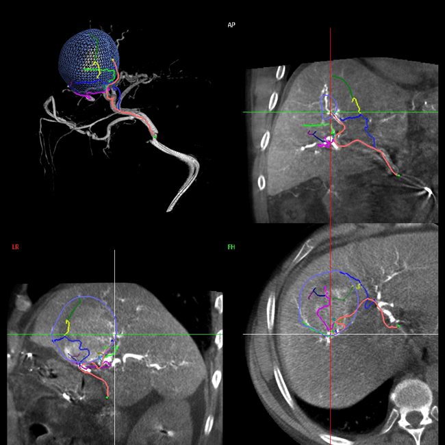 Nueva sala de hemodinamia, Informaci�n para intervenci�n vascular
